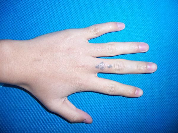 指背文身切除整形术 - 好大夫在线