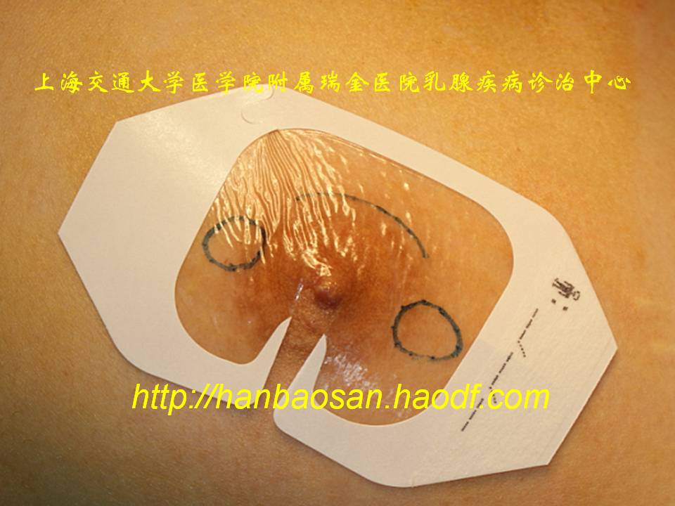 乳腺外科切口設計的潛規則路漫漫其修遠兮吾將上下而求索