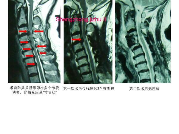 85岁老人腰椎间盘突出,适宜做手术吗?