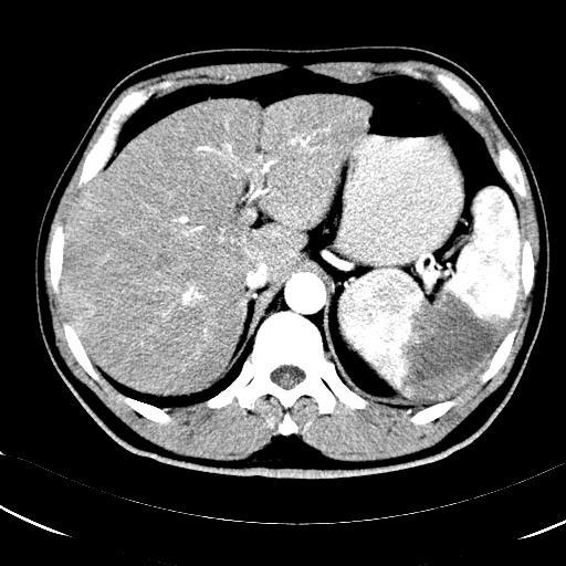 脾梗死_脾切除手术_脾切除手术检查 - 好大夫在线