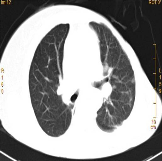 距離夢想還有多遠egfrtki臨床治癒晚期肺癌一例的思考