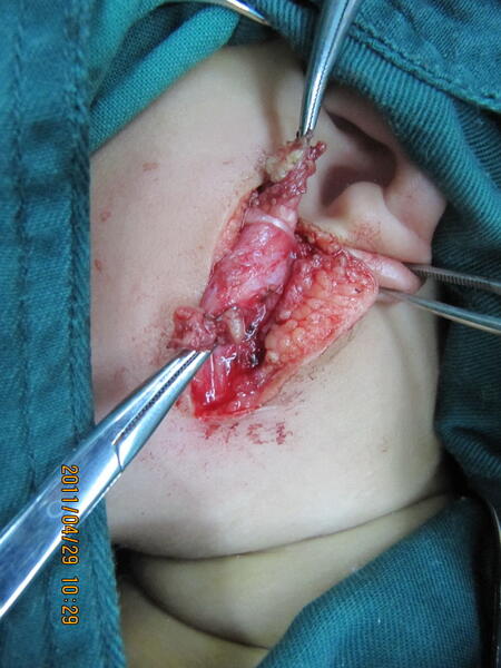 我手术的一例第一腮裂腮瘘,面神经被我解剖的清清楚楚