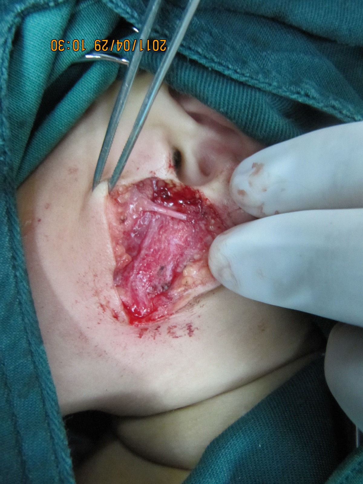 我手术的一例第一腮裂腮瘘,面神经被我解剖的清清楚楚