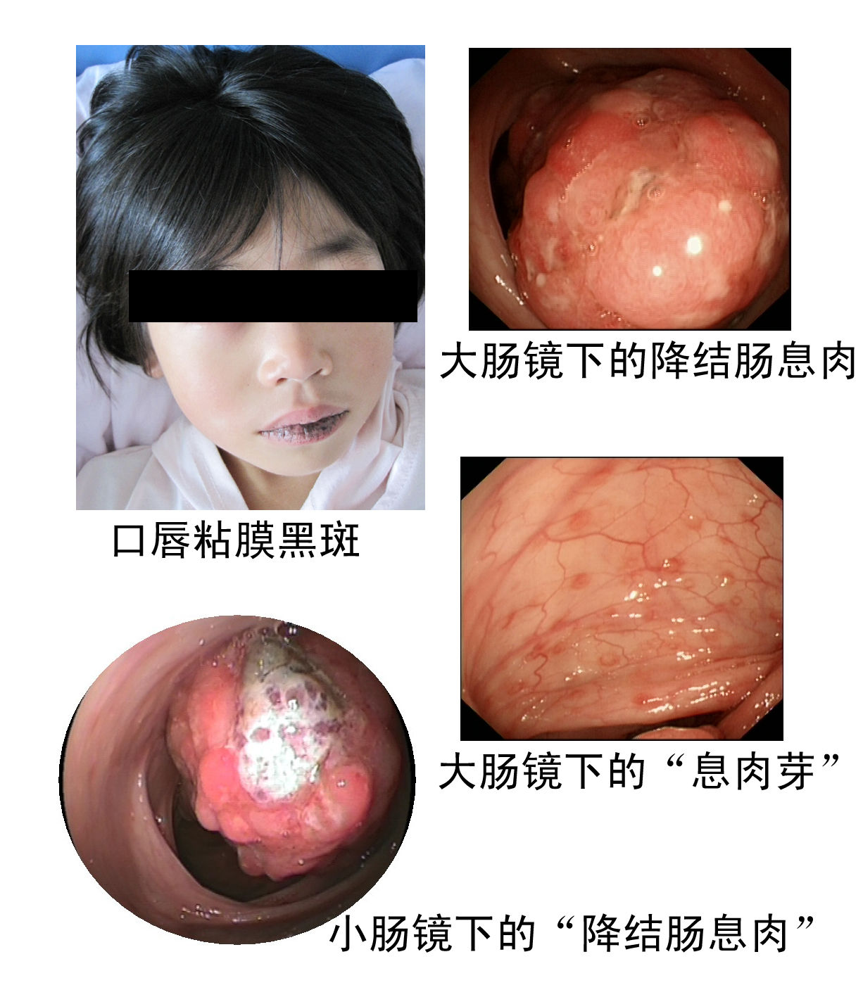 我建了"肠息肉病治疗"群,群号161954845,欢迎全国患者来找我
