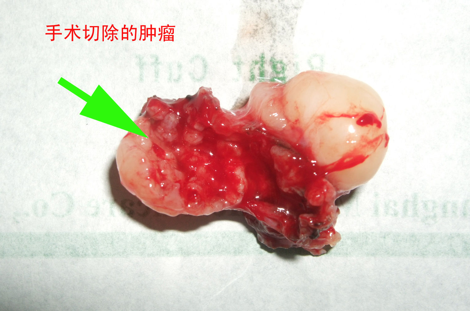 王建华教授病例之2------上颈椎椎管内肿瘤 - 好大夫在线