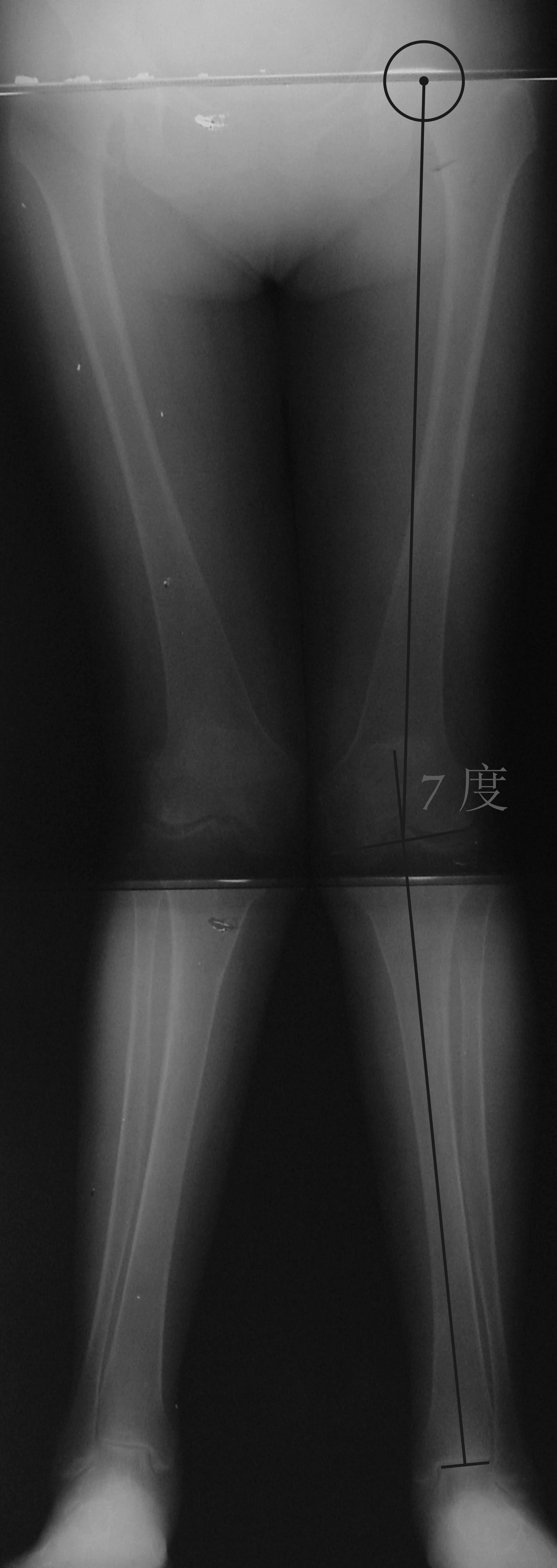 严重膝外翻关节置换