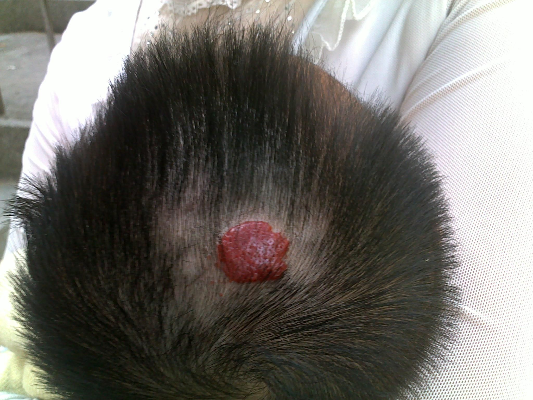 小儿皮肤血管瘤及同位素敷贴治疗 (转载)