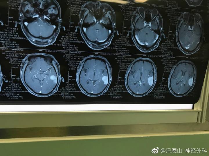 凸面脑膜瘤 (原创)