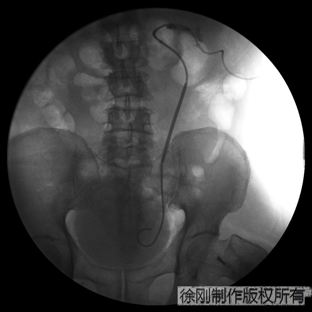 x光监视下球囊扩张治疗输尿管狭窄