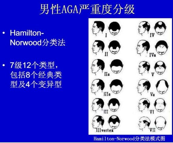 转载:中国雄激素性脱发专家诊疗共识(2009版,