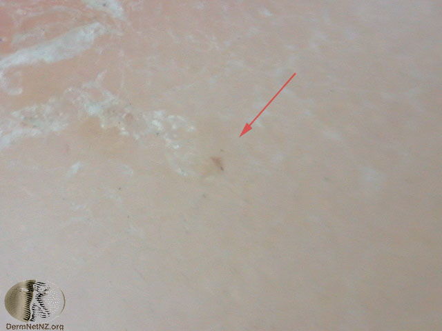 皮肤镜诊断疥疮 - 好大夫在线