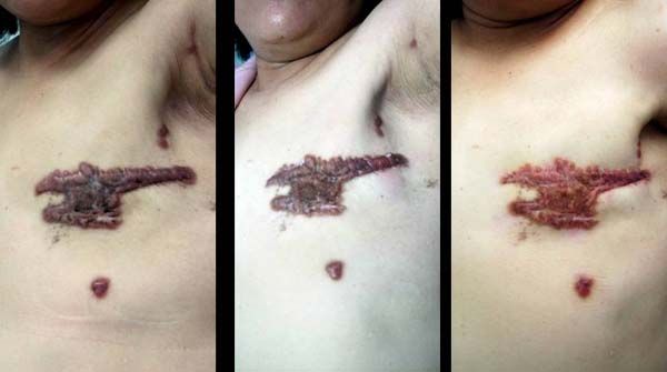 乳癌术后瘢痕疙瘩(大面积厚型) 奇痒难忍,药物注射2次后瘢痕变平变软