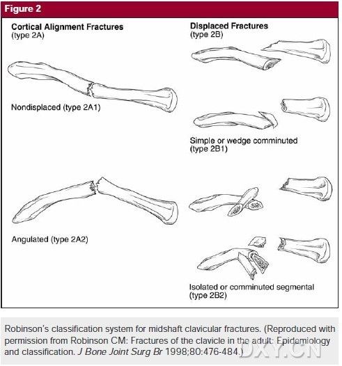 锁骨骨折分型图图片