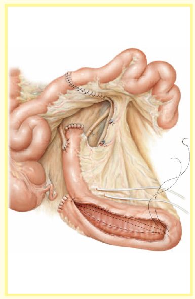 回肠膀胱术示意图图片