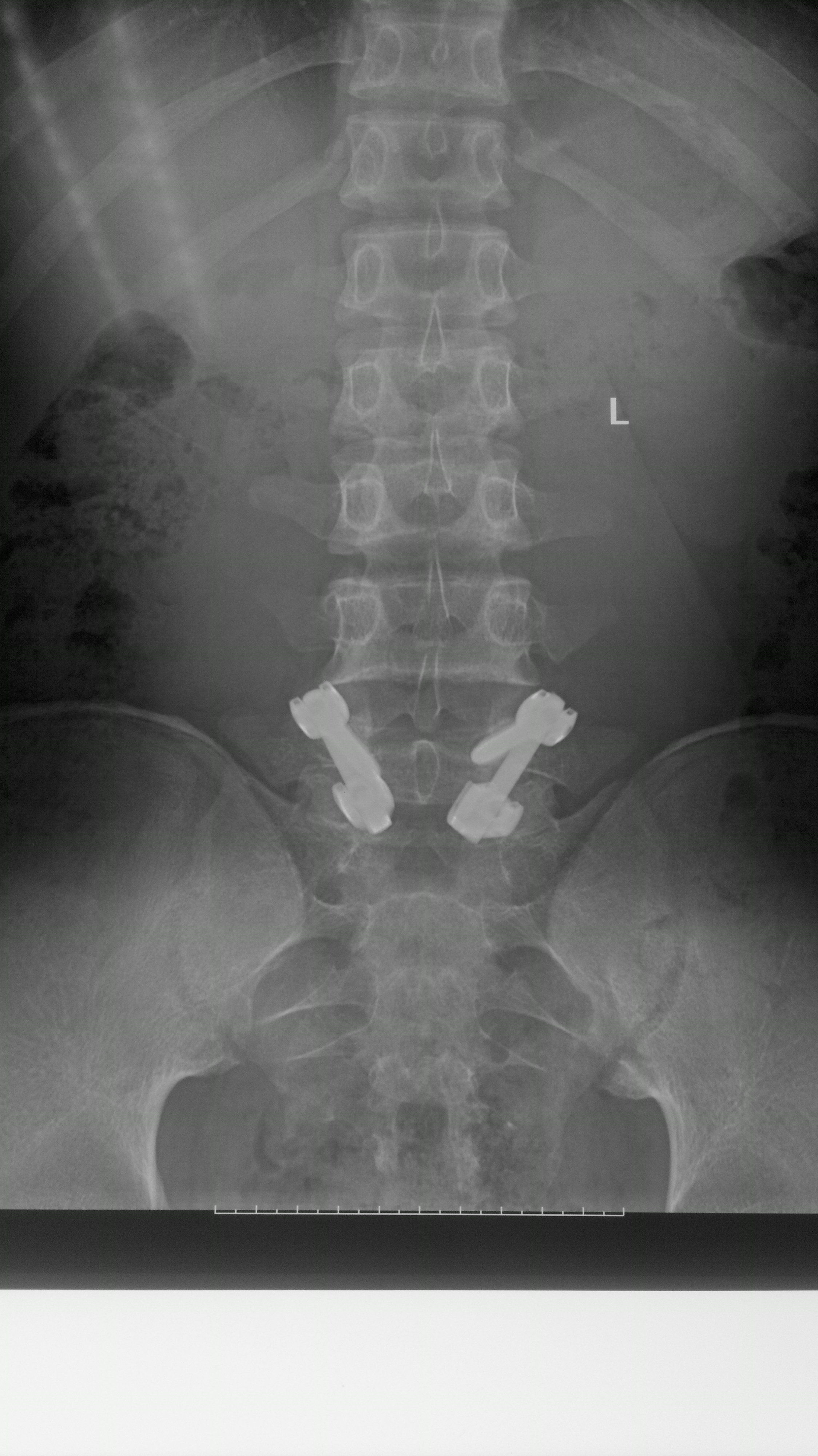 峡部裂+腰椎滑脱1度手术记录(五) - 知乎