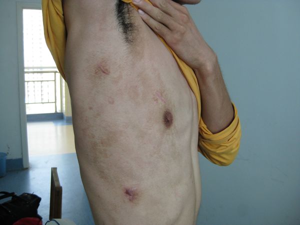 肺大疱、自发性气胸可通过微创手术根治