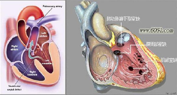 室间隔缺损
