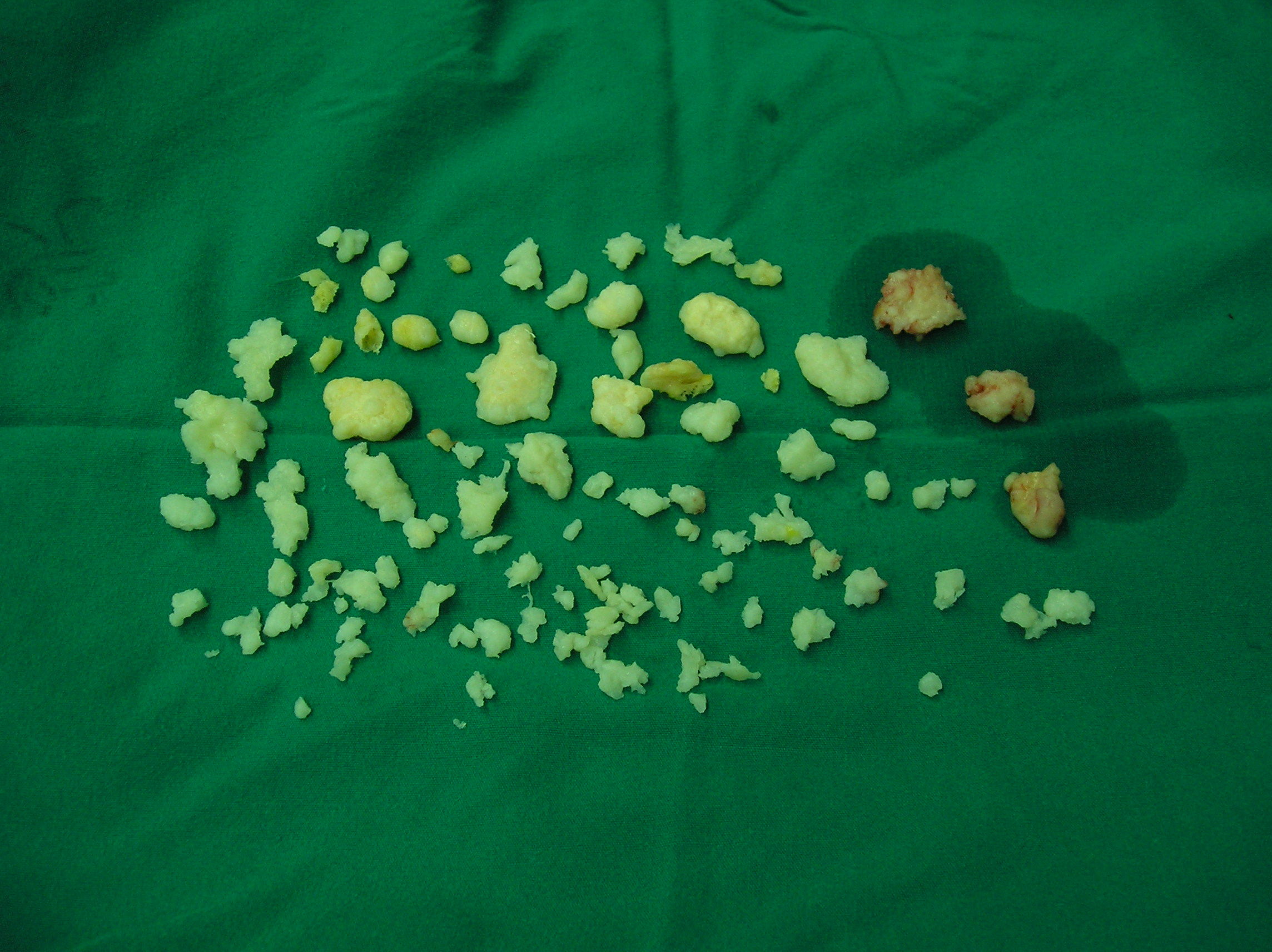 膝关节游离体的治疗