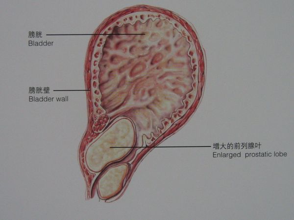 前列腺增生尿道梗阻晚期至膀胱小梁小室形成