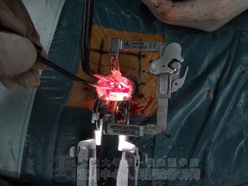 quadrant通道脊柱微创手术治疗腰椎管狭窄症腰椎滑脱症