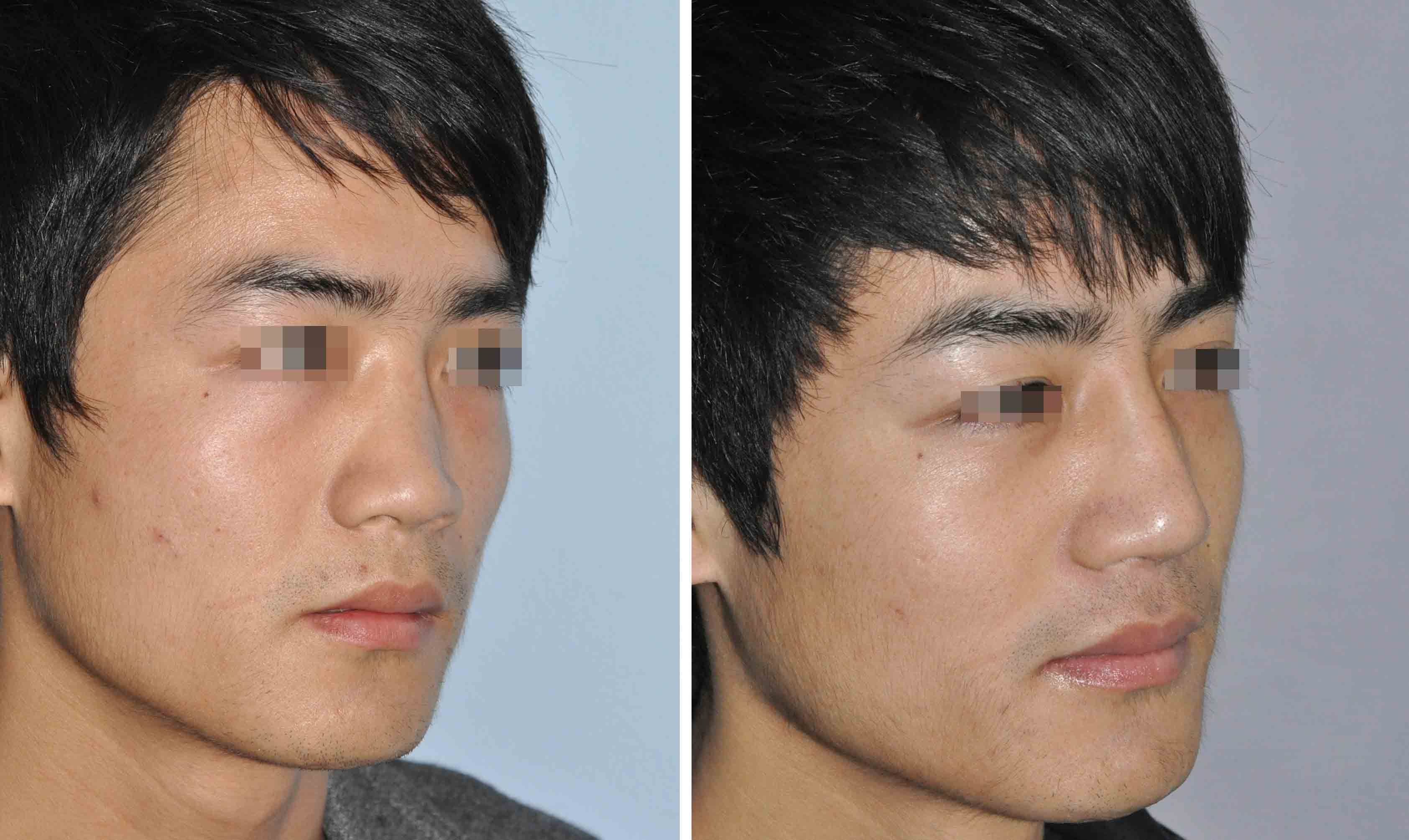 肋骨隆鼻并歪鼻矫正术对比照片 - 好大夫在线