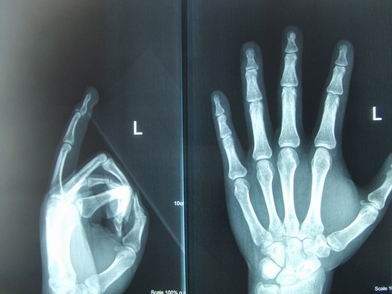 锤状指的诊断与治疗 - 好大夫在线