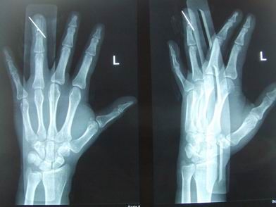 锤状指的诊断与治疗 - 好大夫在线