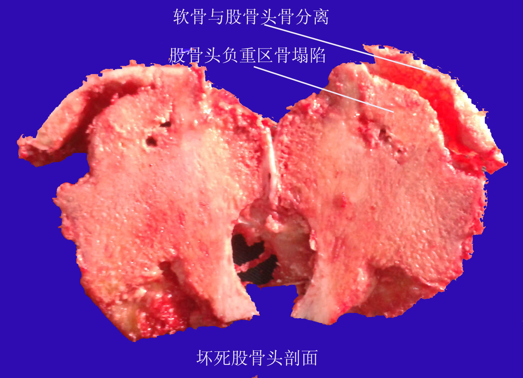 股骨头坏死的终极治疗