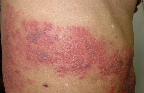 带状疱疹只会出现在腰背部吗?