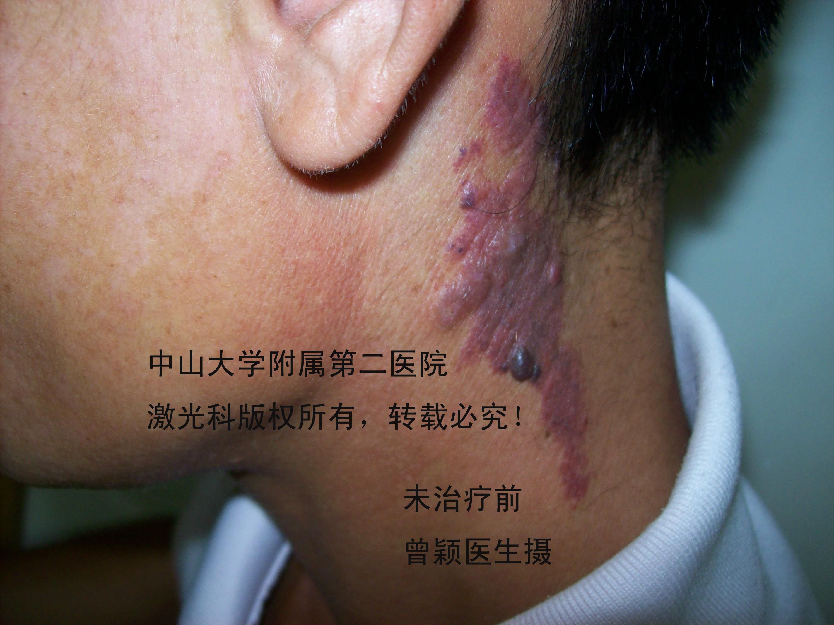 这位患者接近50岁,他的鲜红斑痣治疗效果也不错.