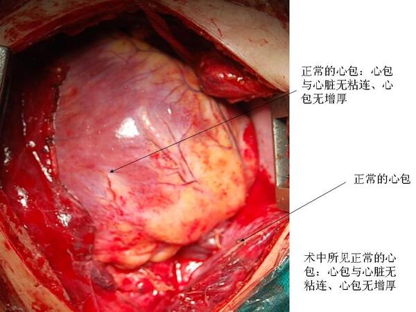 正常的心包:心包与心脏无粘连,心包无增厚