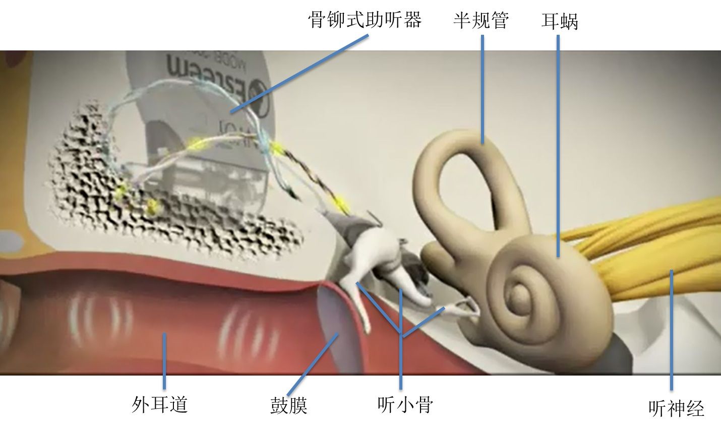 新型助听器-骨锚式助听器(baha)