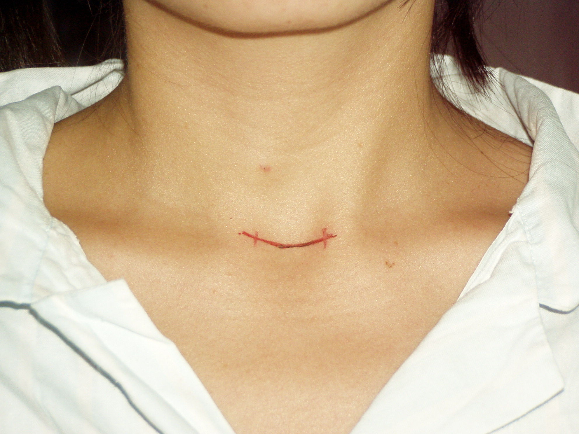 内镜辅助下小切口微创甲状腺手术 - 好大夫在线