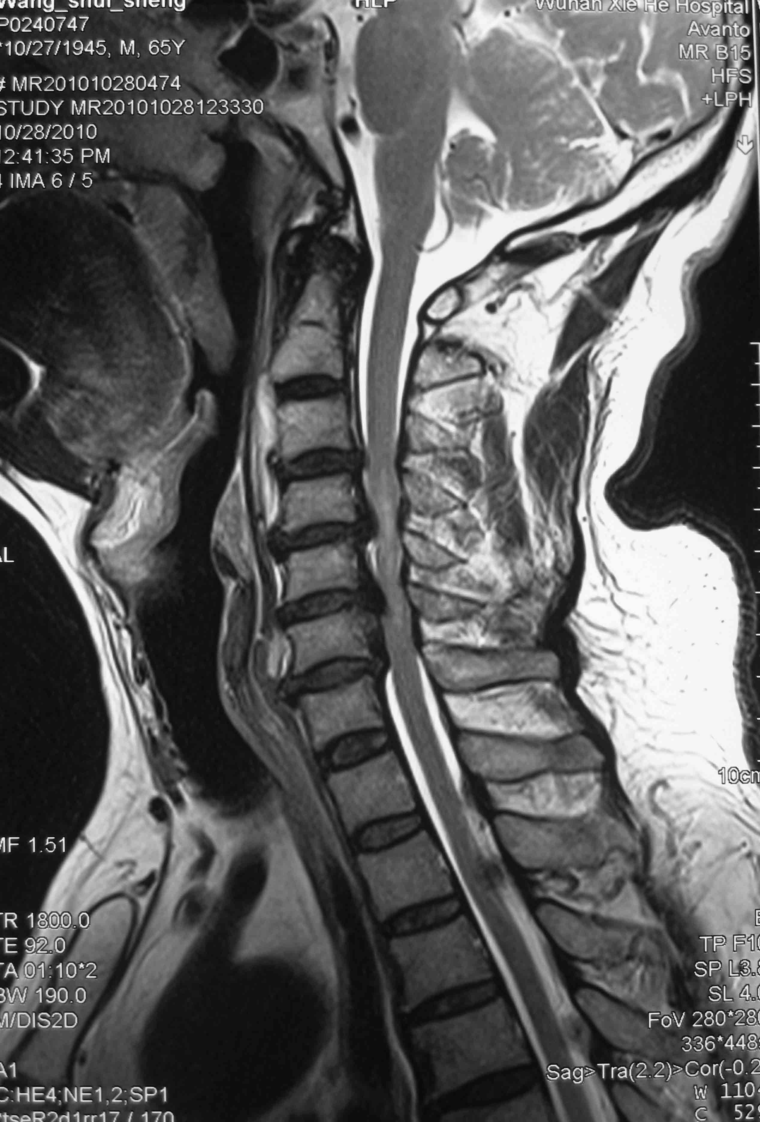 颈椎后纵韧带钙化典型病例 