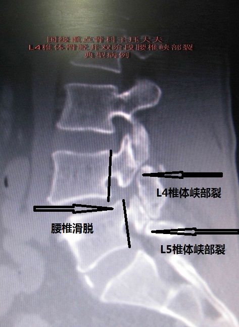 病例4:一例特殊腰椎滑脱病例-双椎体峡部裂,完全复位解除病痛