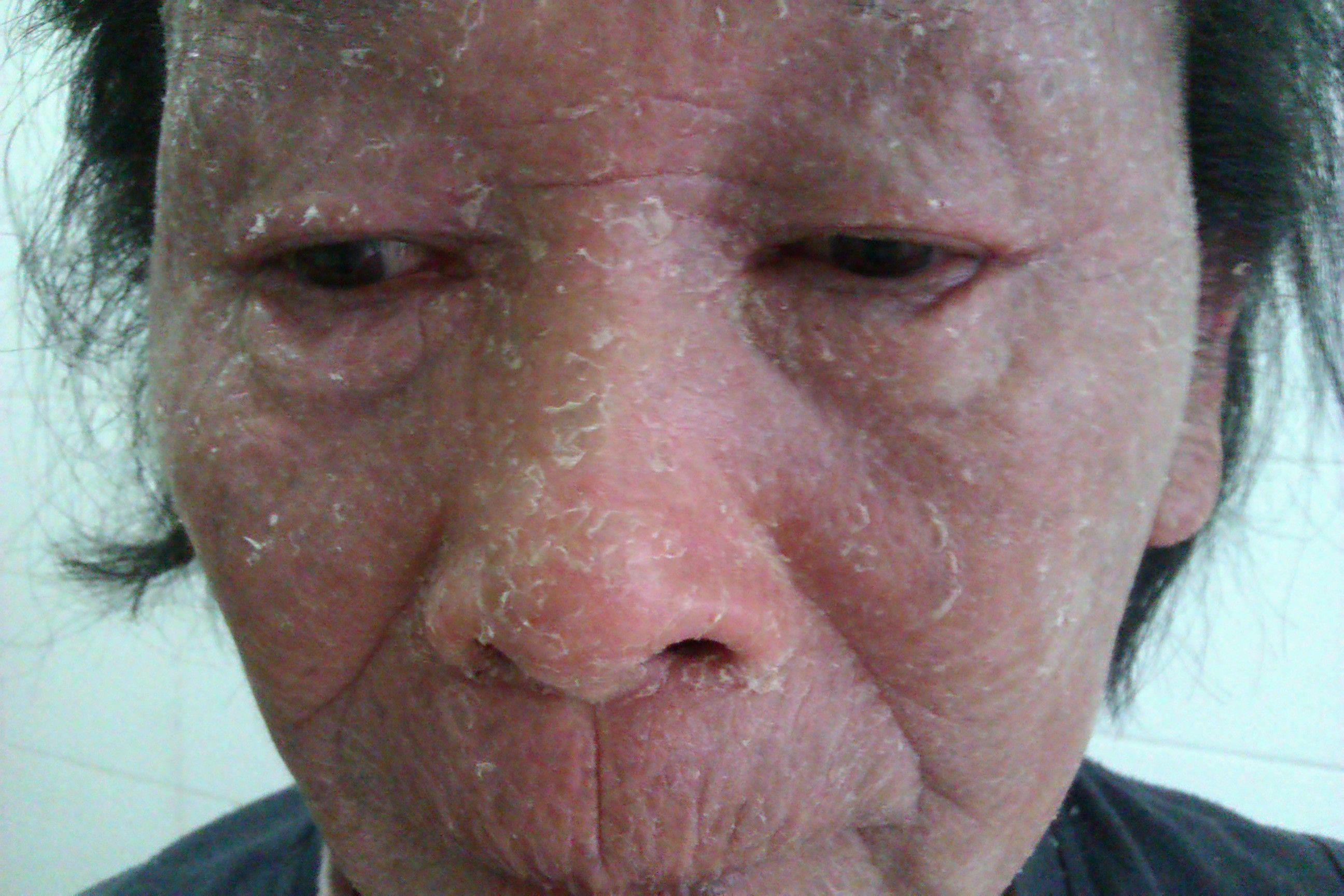 一名红皮病患者的开心笑脸的启示_红皮病_治疗方法_治疗方式 - 好大夫在线