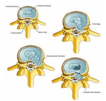 纖維環破裂後髓核突出壓迫神經根造成以腰腿痛為主要表現的疾病.