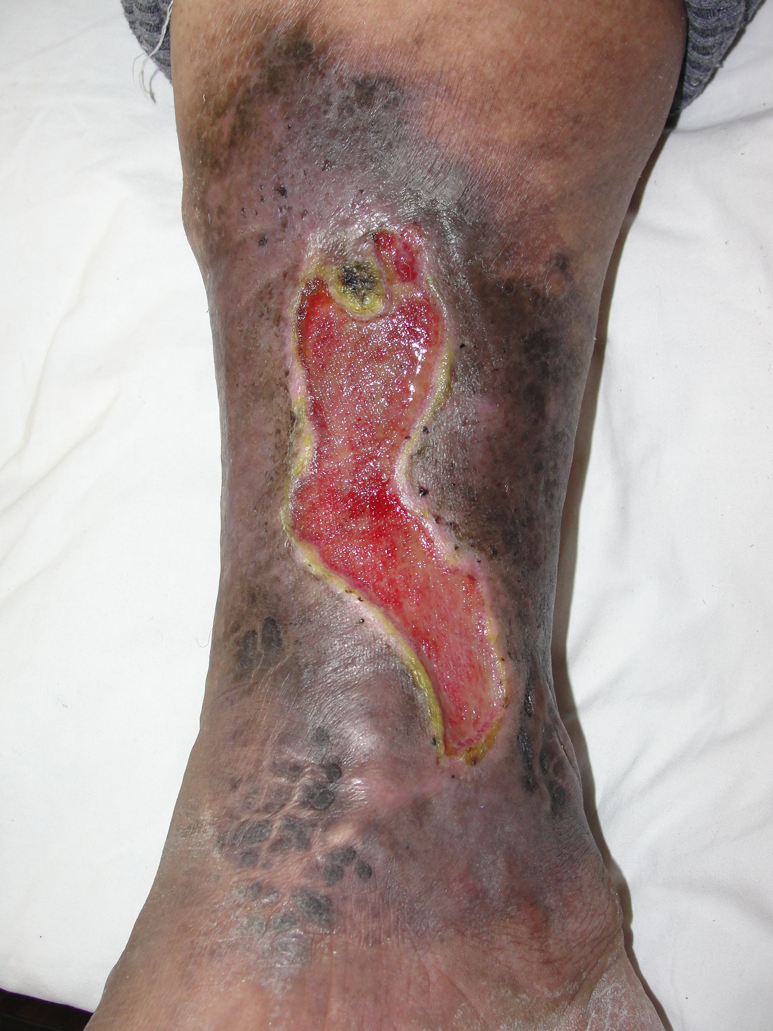 介入治疗陈旧性下肢深静脉血栓形成 - 好大夫在线