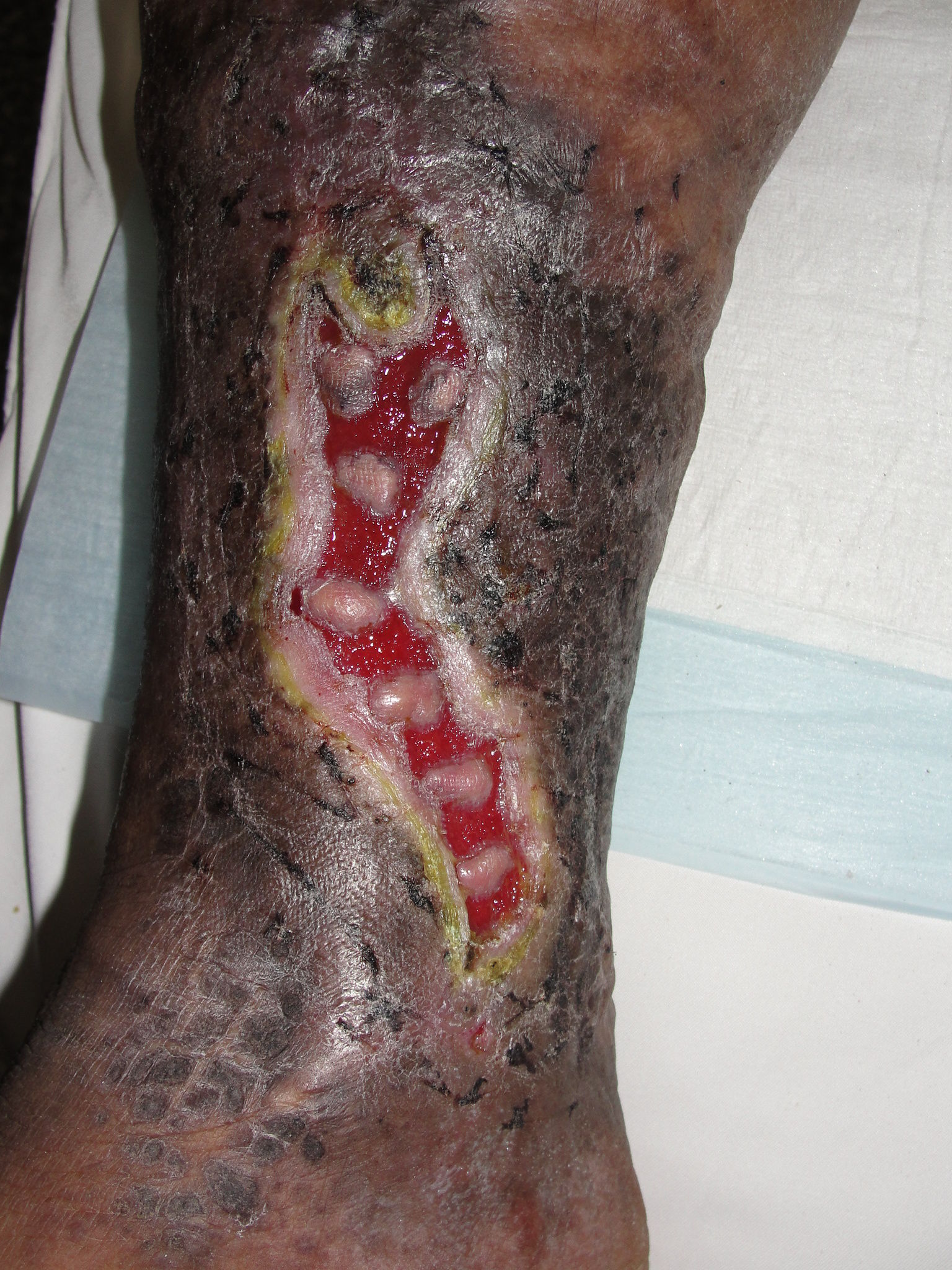 早期小腿静脉血栓图片图片