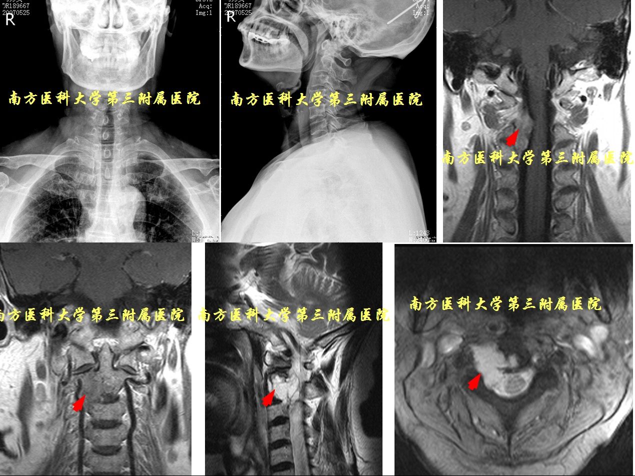 上颈椎肿瘤的切除与重建