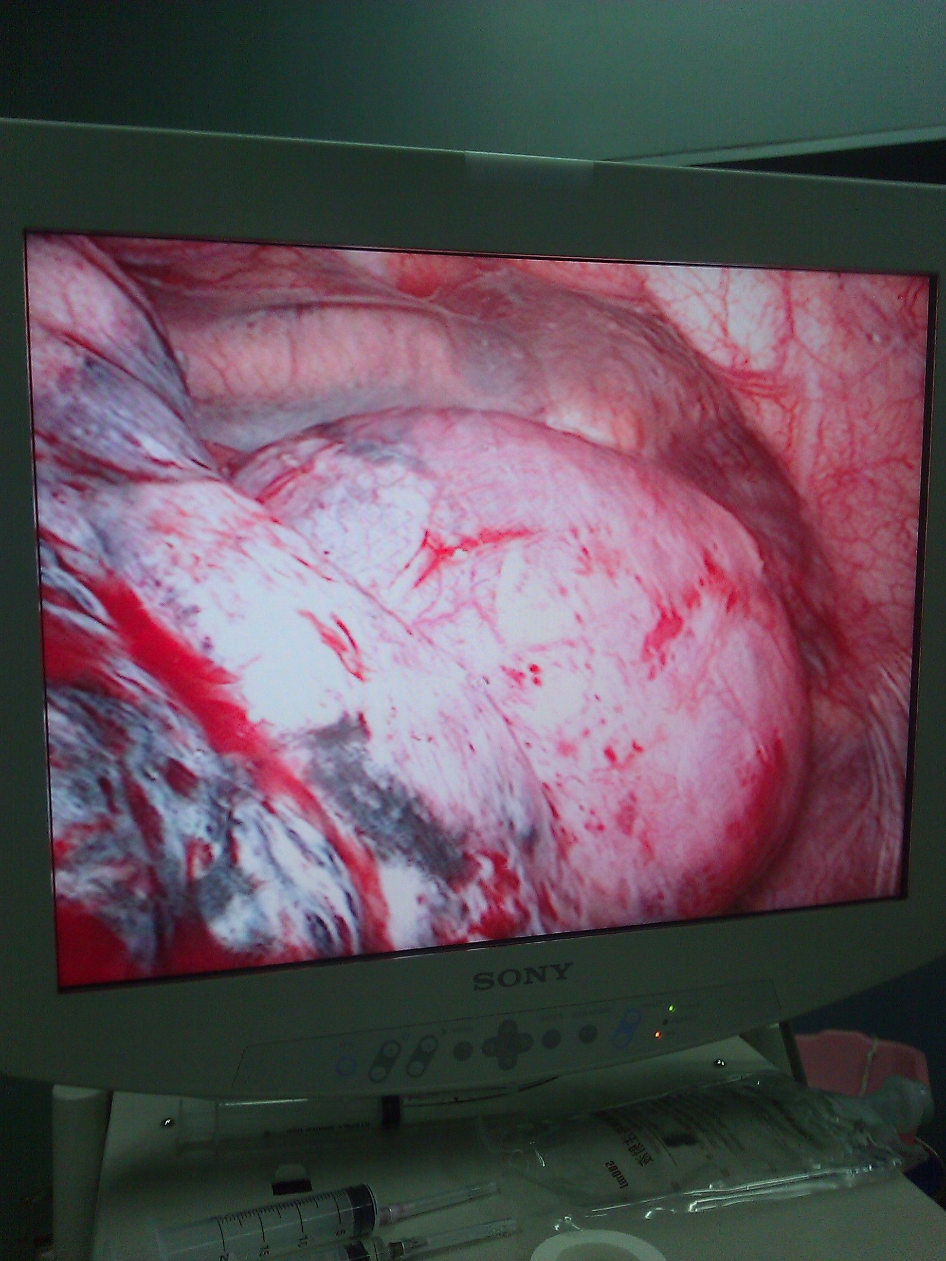肺大泡 胸腔镜图片