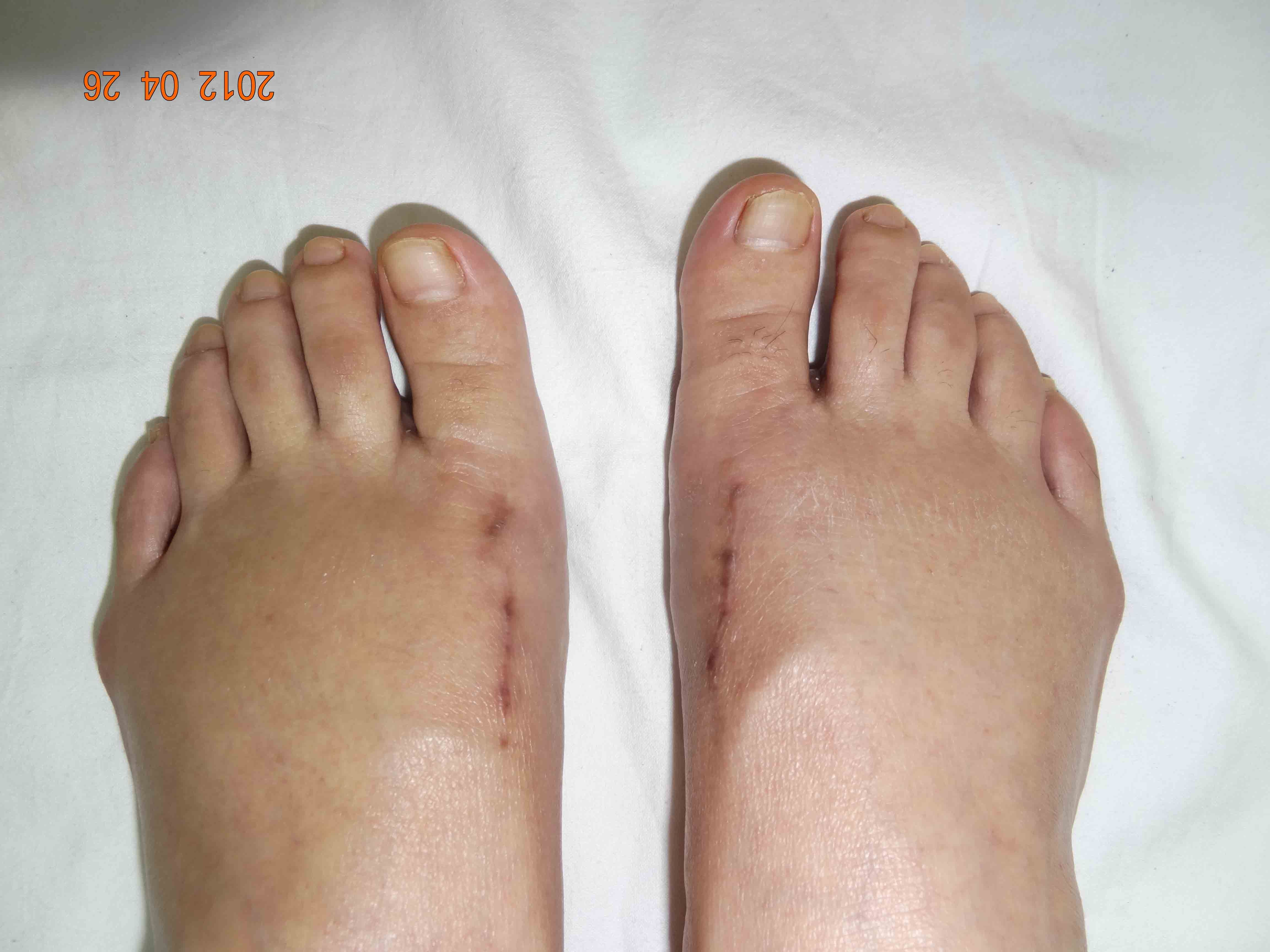 12年第一例拇外翻 更新图片