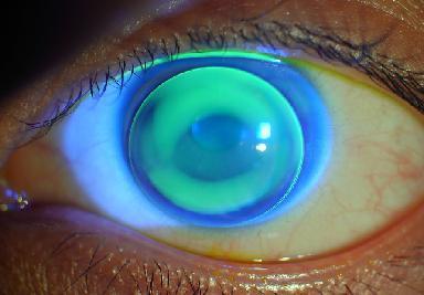 戴rgp前后角膜地形图比较