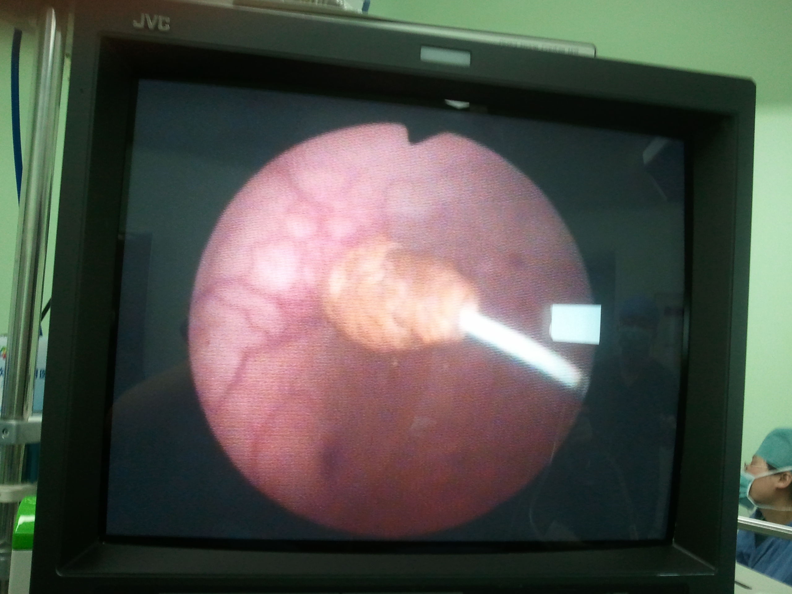 膀胱内异物导致的膀胱结石 - 好大夫在线