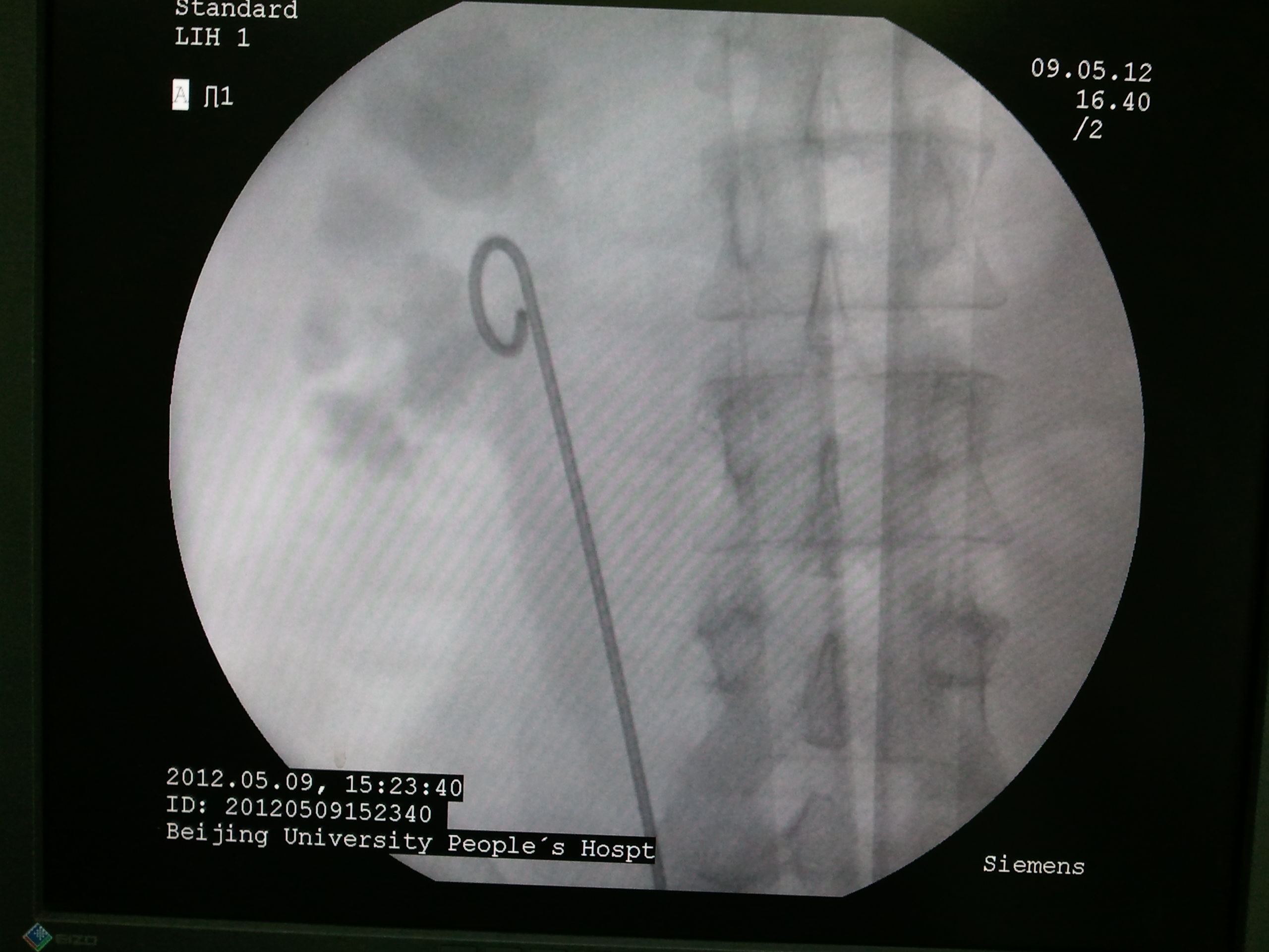 肾结石手术支架图片图片