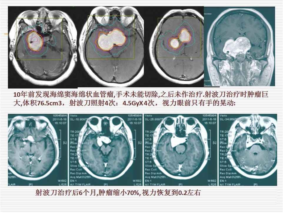 顱內海綿竇海綿狀血管瘤手術治療還是射波刀治療