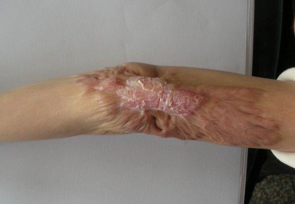 左肘部烫伤后瘢痕挛缩 - 好大夫在线