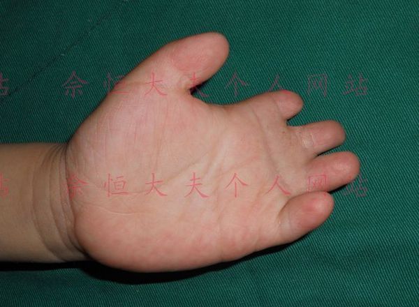 波兰(poland)综合征的手术治疗_胸壁疾病_胸壁疾病手术 - 好大夫在线