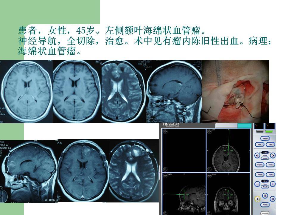 神经导航下颅内海绵状血管瘤切除术