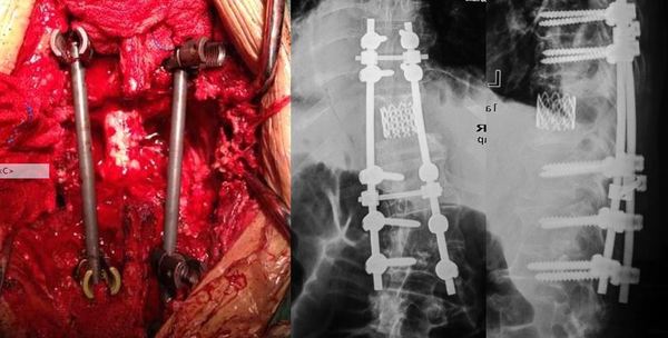 脊柱结核病例26:一例胸椎结核合并截瘫的治疗
